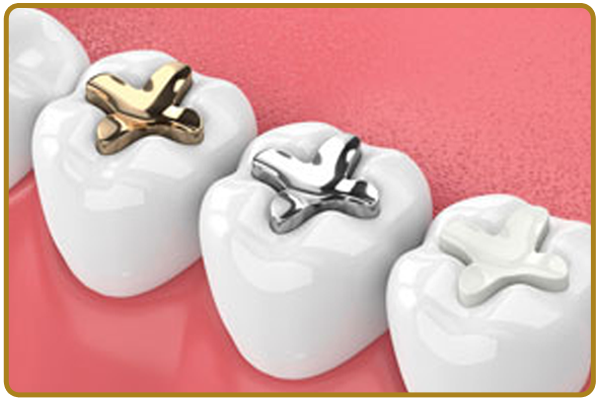 Dental Fillings